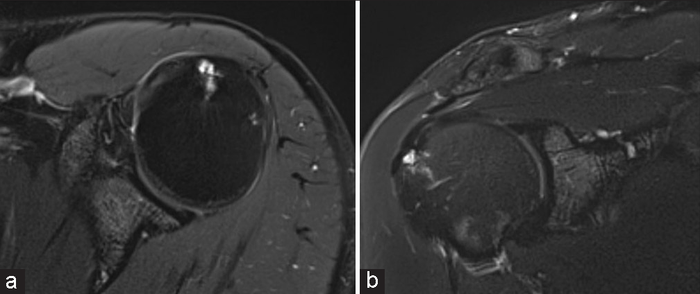 A 39-year-old male presenting with shoulder pain. T2-weighted fat-saturated (a) axial and (b) coronal magnetic resonance images demonstrating traction cysts at the greater tuberosity of the humerus at the attachment of the supraspinatus tendon with surrounding marrow edema.