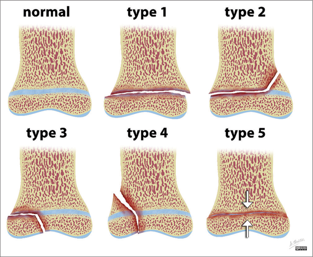 Illustration of Salter-Harris classification for physeal injuries. Case courtesy of Matt Skalski, Radiopaedia.org, rID: 27144.