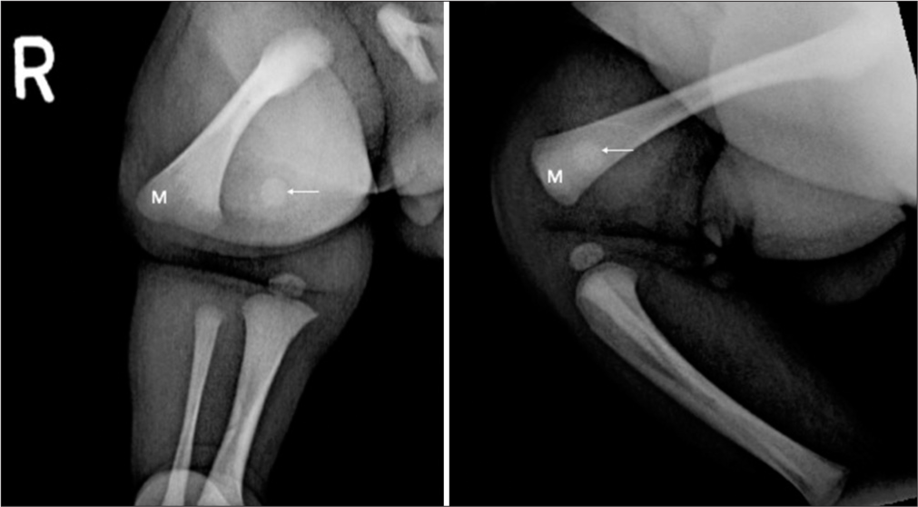 Two-day-old neonate with Salter-Harris I fracture of the distal right femur. Frontal and lateral radiographs of the right knee revealed loss of congruence between the distal femoral epiphysis (arrow) and metaphysis (M).