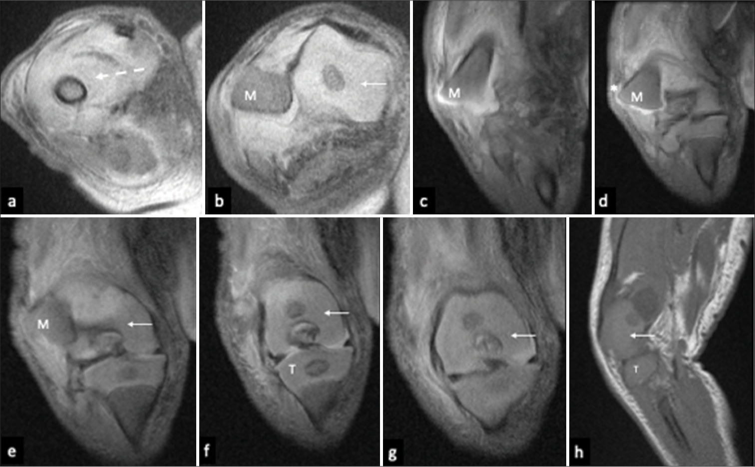 Magnetic Resonance Imaging (MRI) of the right knee revealed distal femoral physeal fracture (Salter-Harris-I) with lateral dislocation of the femoral metaphysis (M). (a and b), Axial PDFS, (c-g) Coronal PDFS and (h) Sagittal T1-weighted MR images revealed marked soft tissue/muscle edema in the anterior thigh distally (dashed arrow), projection of the dislocated metaphyseal end of the distal femur into the subcutaneous fat (asterisk), causing a focal bulge in the overlying skin and preserved congruence of distal femoral epiphysis (cartilaginous femoral condyles) (arrow) with the proximal tibia (T).