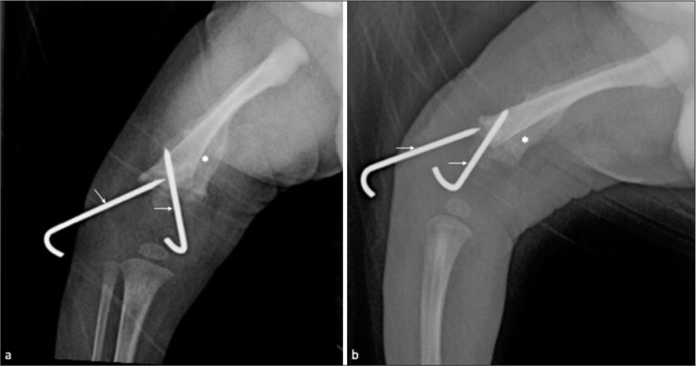 (a) Frontal and (b) Lateral follow-up radiographs, a month later, revealed anatomic alignment of the femur following reduction and pinning (arrow). There was extensive periosteal reaction and new bone formation (asterisk) in the distal femur.