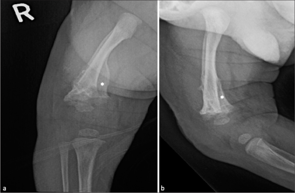 (a), Frontal and (b), Lateral radiographs obtained after a week following pin removal revealed normal alignment of the bones with extensive periosteal reaction (asterisk) in the distal femur.