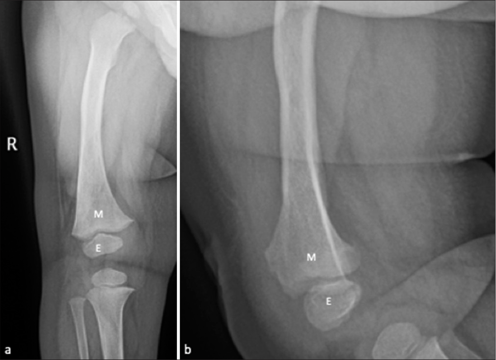 (a), Frontal and (b), Lateral radiographs obtained a year later - revealed normal outline and alignment of the bones, that is, the distal femoral metaphysis (M) and epiphysis (E) without any deformity.