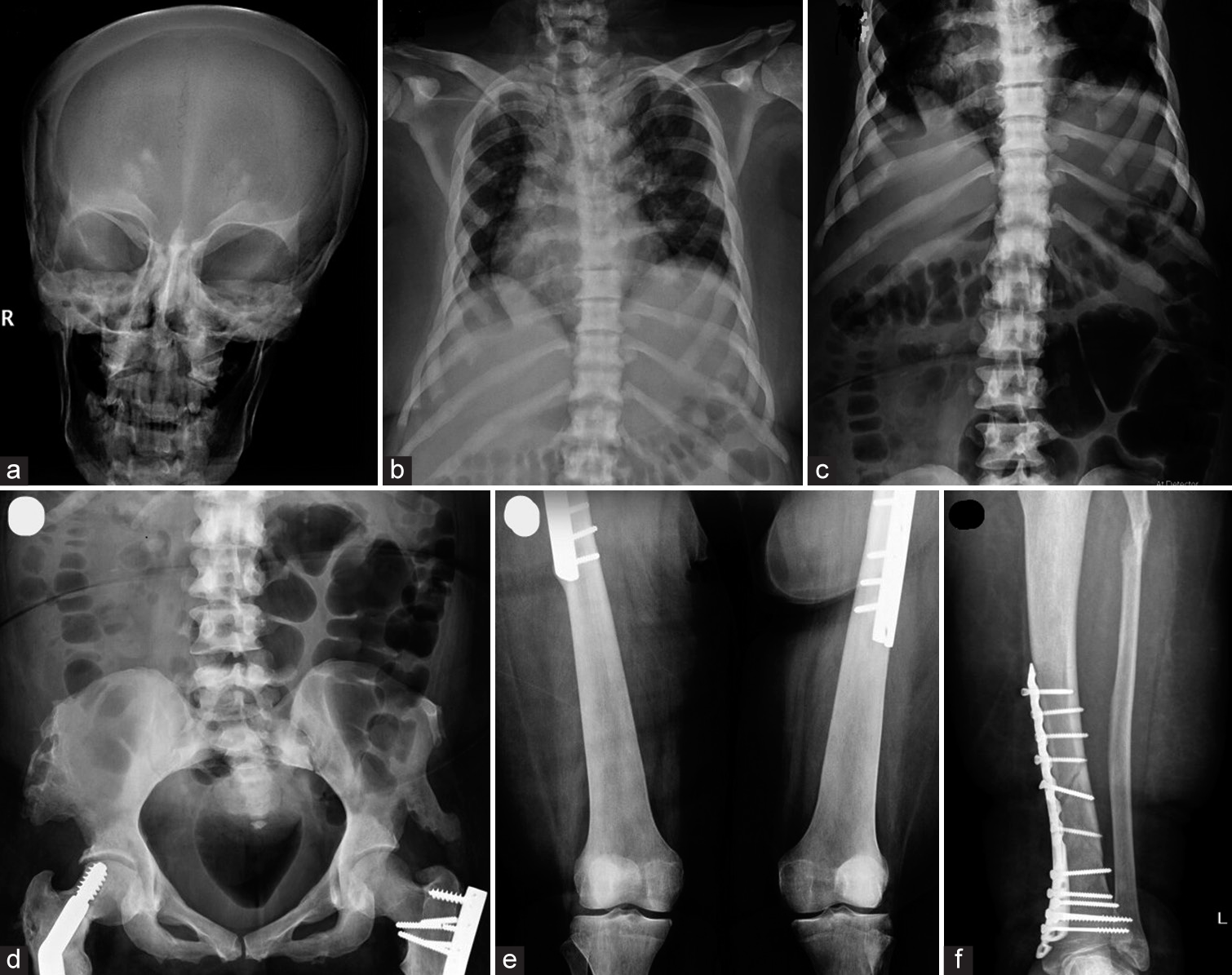 (a) Skeletal survey showing increased bone density and thickened calvarium of the skull with bilateral basal ganglia calcifications. (b & c) The spine showing increased bone density and multiple old rib fractures with callus formation. (d) Pelvis and hip joints showing increased bone density, bony exostosis, and bilateral femoral neck old fractures with metallic fixation. (e) Distal femurs and knee joints showing increased bone density with metallic fixation of proximal femoral shaft fractures. (f) The left leg showing both bones of lower limb fractures with metallic fixation of the distal tibia.