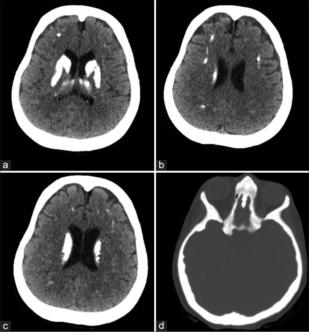 (a-c) Non-enhanced computed radiography of the brain showing bilateral cerebral coarse calcifications involving basal ganglia, thalami, and periventricular white matter and (d) generalized increased calvarial bone density.