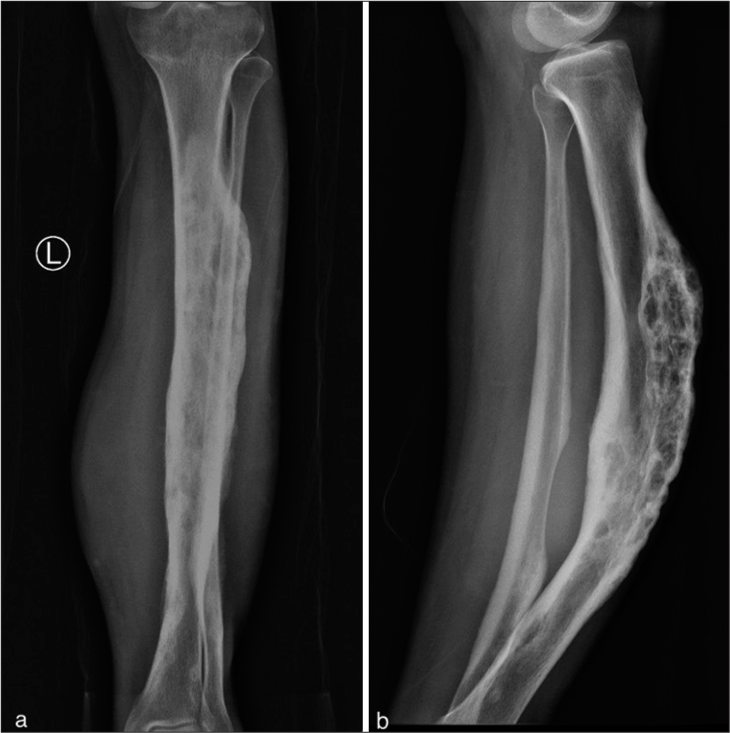 (a) Anteroposterior (b) Lateral radiograph of left leg showing large soft-tissue fullness, which causes pressure erosion and reactive sclerosis over adjoining aspects of tibia and fibula. There is anterior bowing of tibia with large craniocaudally oriented lytic-sclerotic area as a result of disorganized bone growth and coarsened trabeculae involving anterior cortex of left tibia.