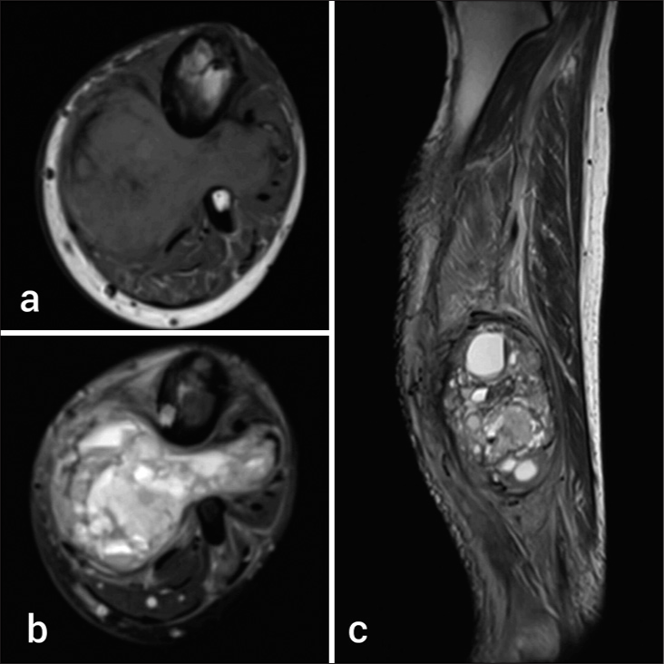 40-year-old man with left lower limb swelling. (a) Axial T1-weighted image shows well-defined hypoisointense lobulated dumbbell like mass. (b) Axial T2/Fat saturation and (c) Sagittal T2-weighted image showing heterogeneous solid mass with multiple cystic spaces showing fluid-fluid levels within. There is reactive cortical thickening and scalloping over contiguous shafts of tibia and fibula.