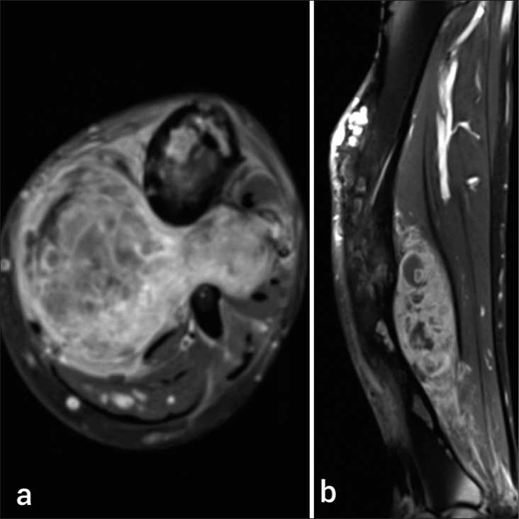 (a) Axial and (b) Sagittal T1 post-contrast images showing heterogeneous contrast enhancement of the lesion. The secondary bone changes are limited to cortex and marrow is free from the disease infiltration.