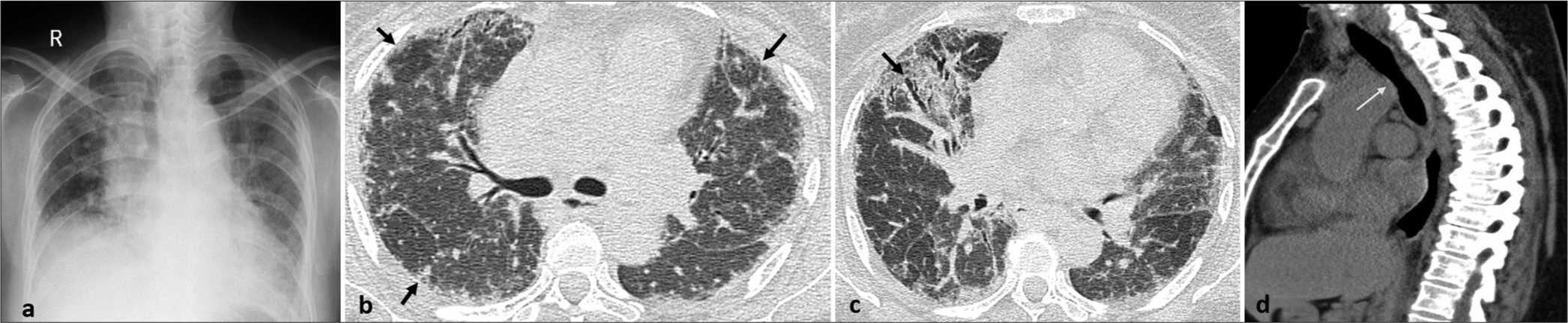 (a) Chest radiograph frontal view shows cardiomegaly with ill-defined densities and reticular opacities in bilateral lung fields. (b and c) High-resolution computed tomography chest axial image shows subpleural interstitial thickening and fibrosis with tractional bronchiectasis (arrows). (d) Computed tomography chest sagittal image in soft-tissue window shows dilated esophagus (arrow).