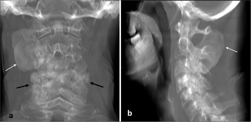 (a and b) Radiographs of cervical spine, anteroposterior and lateral views. It shows a well-defined paravertebral radiopaque lesion (white arrows) in close relation with the posterior elements of spine and facetal sclerosis (black arrow).