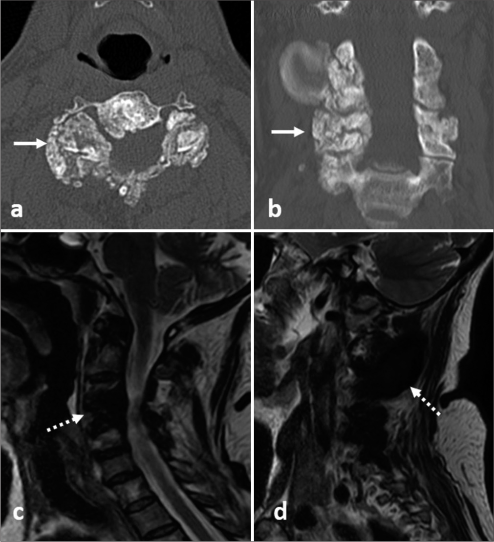 (a and b) Computed tomography cervical spine axial and coronal images. (c and d) Magnetic resonance imaging (MRI) cervical spine T2 turbo-spin-echo sagittal images. Parasagittal section. Show extensive bilateral fluffy soft-tissue calcifications (arrows) predominantly around facet joints and lamina from C2/C3 level to C5/C6 level. Hypointense areas in corresponding MR images (dotted arrow).