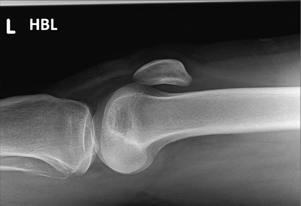 Lateral radiograph of the left knee demonstrating prepatellar soft-tissue swelling but no bony injury, effusion, or lipohaemarthrosis. HBL: Horizontal beam lateral.