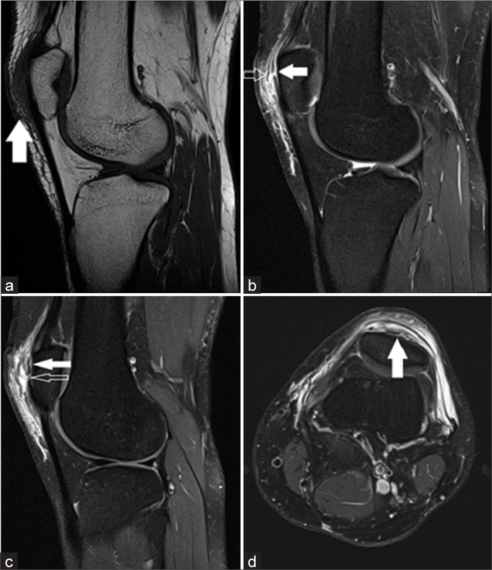 (a) Sagittal T1-weighted and (b and c) Sagittal and (d) Axial proton-density fat-saturated sequences of the left knee demonstrating prepatellar soft-tissue swelling of T1-weighted intermediate-tohypointense signal (a – solid arrow). Disruption of the superior prepatellar quadriceps continuation fibers (b – solid arrow) and overlying fascial layers (b – open arrow) with associated surrounding high signal on proton-density fat-saturated sequences consistent with partial tearing and edema. There is stripping of the superior prepatellar quadriceps continuation from the anterior patellar surface (c and d – solid arrow) with associated tear (c – open arrow).