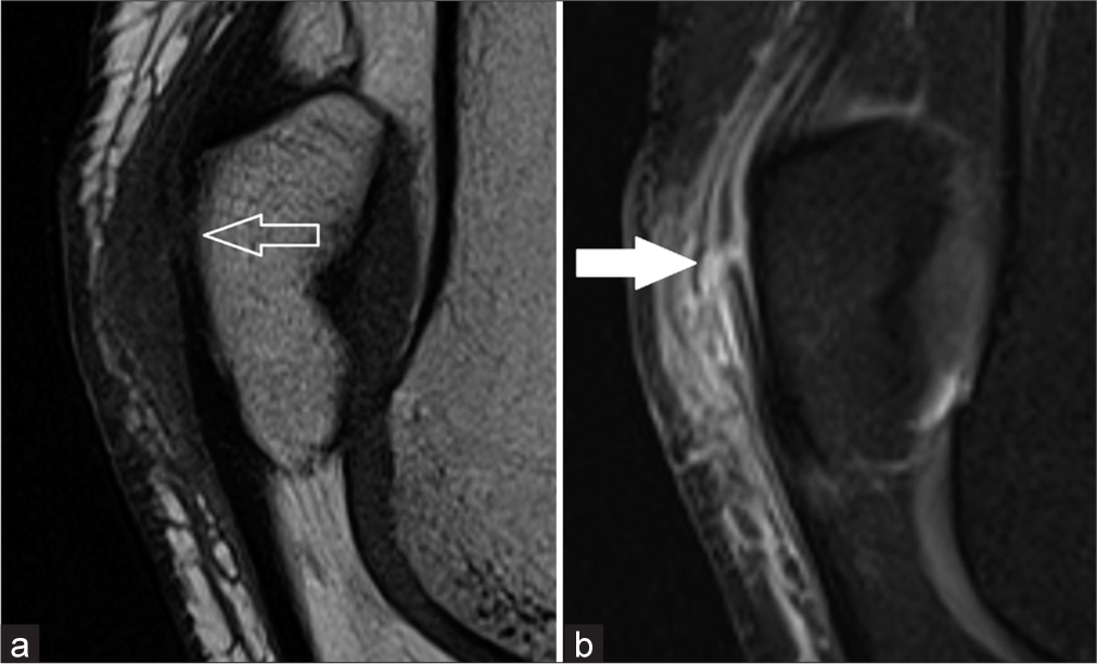 (a) Zoomed sagittal T1-weighted and (b) Proton-density fat-saturated sequences further demonstrating the disrupted prepatellar quadriceps continuation fibers (b - solid arrow) but an intact anterior patellar cortex with no fracture (a - open arrow).