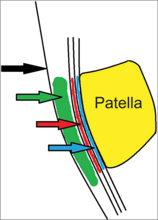 Schematic illustration depicting the prepatellar structures and the intervening potential spaces in the sagittal plane. Black arrow – skin. Green arrow – subcutaneous prepatellar bursa. Red arrow – potential space between most superficial and intermediate layers of the prepatellar quadriceps continuation, i.e., subfascial component of prepatellar bursa. Blue arrow – potential space between the intermediate and deep layers of the prepatellar quadriceps continuation, i.e., subaponeurotic component of prepatellar bursa.