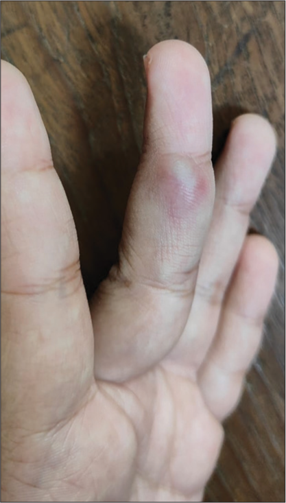 A 27 year old woman presented with a swelling over her left middle finger. The swelling is reddish with a smooth overlying skin.