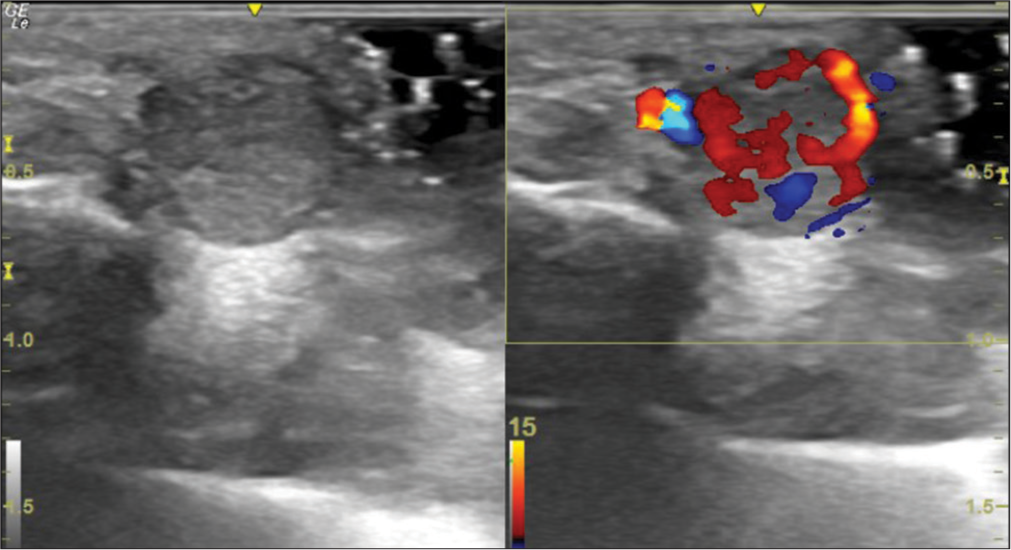 A 27-year-old woman with an arteriovenous fistula of the digit presented with swelling over her left middle finger. Ultrasound of the lesion with the probe perpendicular to the long axis of the finger shows a well-defined heterogeneously hypoechoic lesion in the subcutaneous plane, with vascularity.