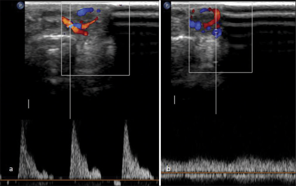 A 27 year old woman with an arteriovenous fistula of the digit presented with swelling over her left middle finger. (a) Arterial waveform on Doppler spectrum, (b) Venous waveform on Doppler spectrum.