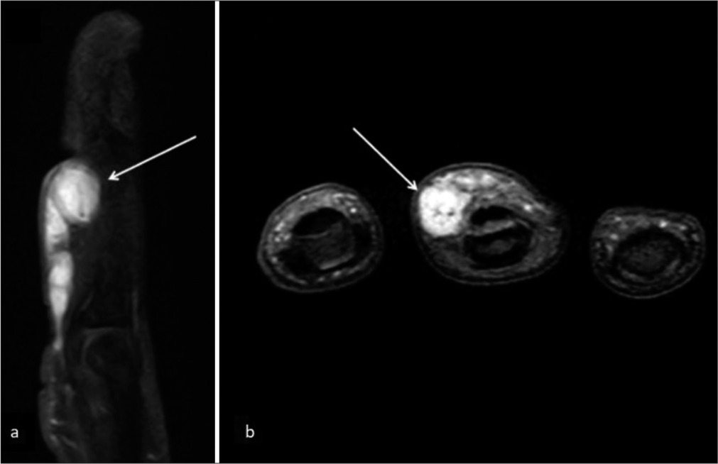 A 27 year old woman with an arteriovenous fistula of the digit presented with swelling over her left middle finger. MRI of the finger in the short tau inversion recovery sequence shows: (a) A well defined hyperintense lobulated round lesion (arrow) with a serpiginous proximal extension, (b) The lesion (arrow) is separate from the flexor tendon, located eccentrically towards the radial aspect of the finger.