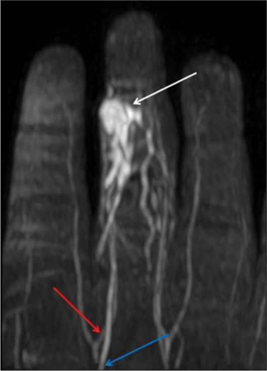 A 27-year-old woman with an arteriovenous fistula of the digit presented with swelling over her left middle finger. Dynamic magnetic resonance angiography MIP image shows the lesion (white arrow) with an arterial feeder (red arrow) from the radial branch of the proper digital artery of the middle finger. There is an early draining vein (blue arrow). MIP: Maximum intensity projection.