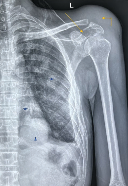 Anteroposterior view radiograph of the right shoulder joint in a skeletally mature adult demonstrates a destructive lytic lesion centered in the left scapular spine and acromion (arrow). This lytic lesion shows ill-defined non-sclerotic margins with a wide zone of transition, no periosteal reaction, and a significant extraosseous soft-tissue component (elbow arrow) protruding superiorly displacing the adjacent fat pads. No internal mineralized matrix is appreciable. Of note, multiple variable-sized well defined round-oval radio-opaque masses are seen randomly distributed in the left hemithorax (star) with the dominant mass overlying the cardiac silhouette (arrowhead).