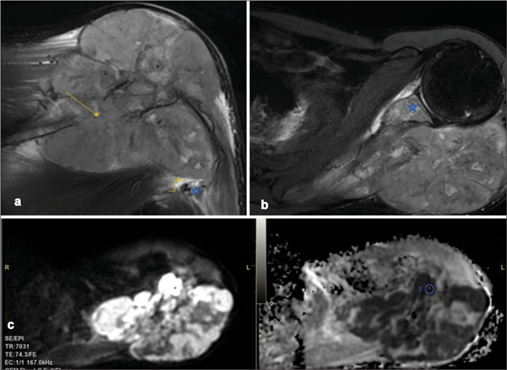 (a) Coronal T2-weighted (T2W)-fat-saturated image demonstrates an intraosseous bony lesion (arrow) in the scapular spine with significant soft-tissue causing bony destruction and spread into adjacent soft tissues. The axillary neurovascular (star) bundle along the inferolateral aspect of the bone primary is devoid of any tumor contact with no abutment/encasement (elbow arrow). (b) Axial T2W-fat saturated image demonstrates intra-osseous spread into the glenoid (star) and its subchondral aspect signifying glenohumeral joint involvement. The mass demonstrates no areas of osseous/chondroid/adipocytic/fibrous/hemorrhagic matrix. (c) Diffusion-weighted imaging (b-value 800s/mm2) and corresponding ADC map show the mass predominantly diffusion restricting with a minimum ADC in the most restricting component of 0.227 × 10−3mm2/s.