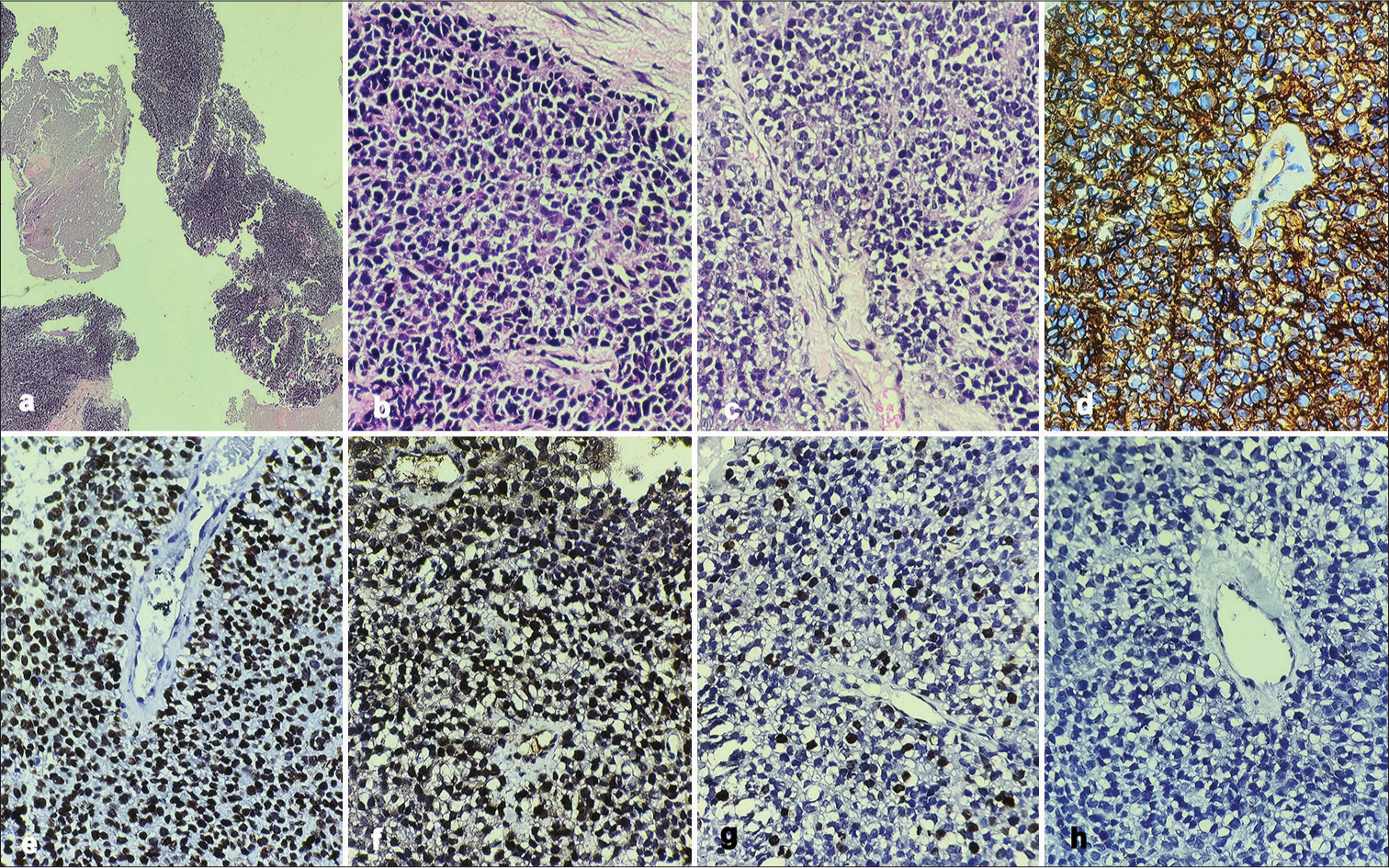 (a-c) Mildly pleomorphic small round blue cells with scant cytoplasm, irregular hyperchromatic nucleus, and inconspicuous nucleoli. Cytoplasmic clearing is appreciated in 50–60% of cells. (a- Hematoxylin and Eosin [H&E], ×10; b and c- H&E, ×40); (d) The tumor cells show diffuse membranous positivity with CD 99 (×40); (e) Diffuse nuclear positivity with NKX2.2 (×40); (f) Nuclear positivity with ETV4 (×40); (g) Ki 67 proliferative index was 30–35% (×40); (h) The tumor cells were negative with BCOR (×40).