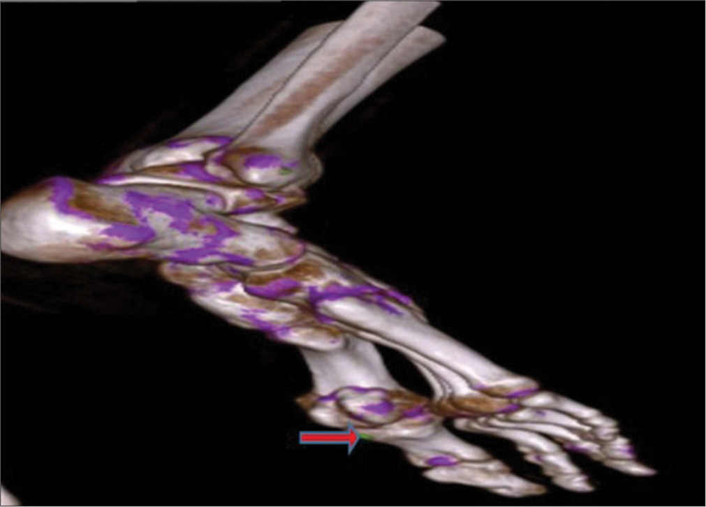 Volume rendered dual-energy computed tomography image shows green color-coded monosodium urate crystal (shown by red arrow) along the inferior-lateral aspect of the 1st metatarsophalangeal joint.
