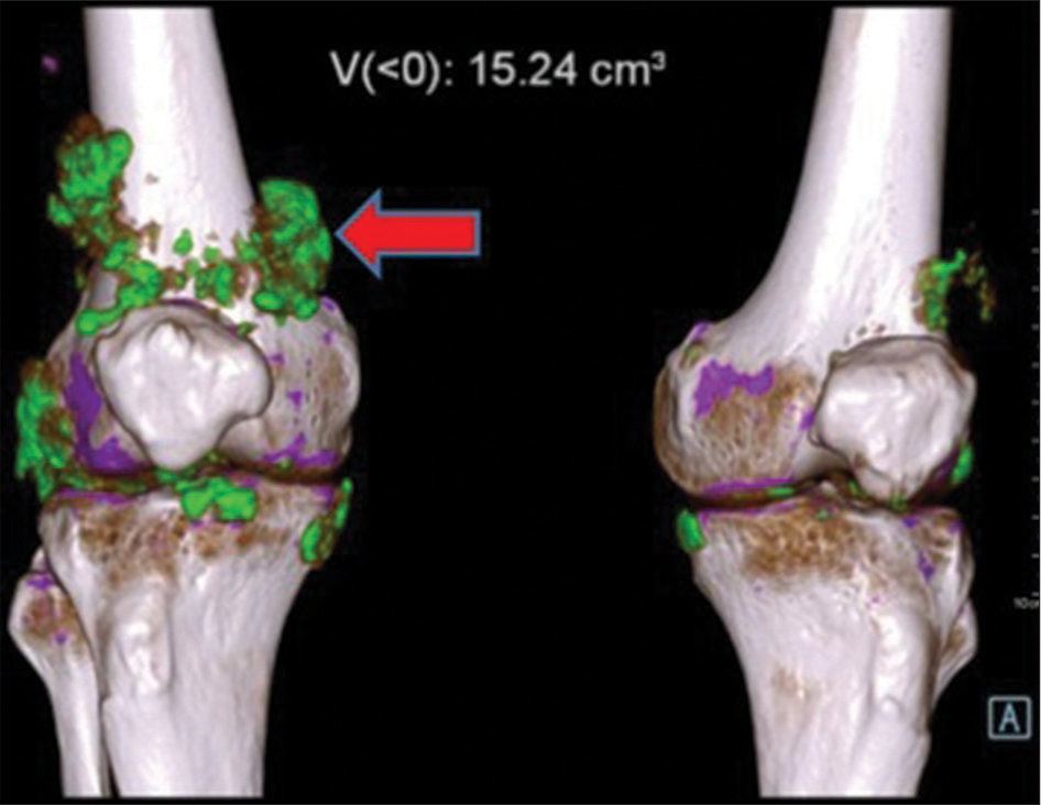 Volume rendered dual-energy computed tomography image shows green color-coded monosodium urate crystals (shown by red arrow) along the popliteus tendon, medial and lateral collateral ligament, patellar ligament of right knee joint and articular surfaces of both knee joints.