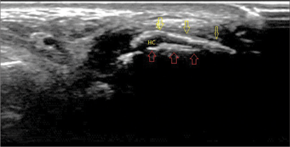 Ultrasound image of the first metatarsophalangeal joint in longitudinal plantar view showing double contour sign in which monosodium urate crystals (yellow arrows) characterized by an echogenic line on the hypoechoic hyaline articular cartilage parallel to the bony contour of the joint (red arrows). (HC: Hyaline cartilage).