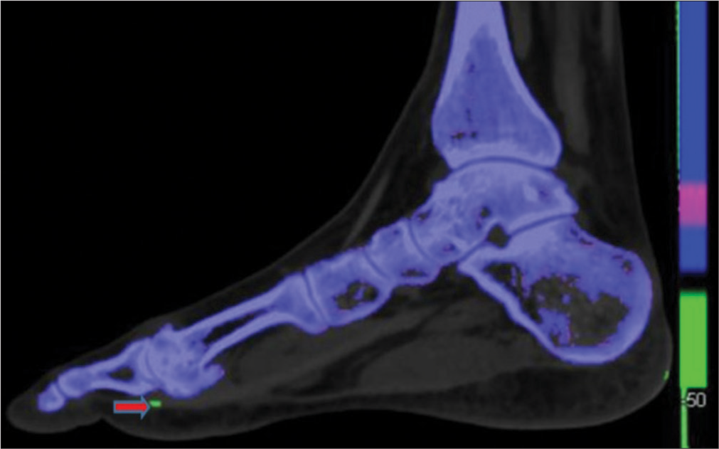 Dual energy computed tomography image of foot in the sagittal plane shows green color coded monosodium urate crystal (shown by red arrow) along the inferior-lateral aspect of the1st metatarsophalangeal joint.
