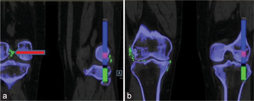 Dual-energy computed tomography image in the coronal section shows green colour-coded monosodium urate (MSU) deposits (shown by red arrow), (a) along the cruciate ligaments of right knee joint, (b) MSU deposits along the popliteus tendon, medial and lateral collateral ligament of right knee joint and articular surfaces of both knee joints.