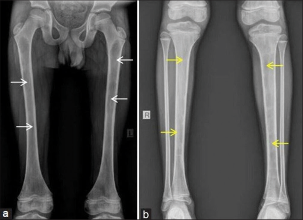 (a and b) Frontal plain radiographs of both thighs and legs showing near diffuse radioluceny with multiple lytic lesions in medullary cavities of both femurs (white arrows) and tibia (yellow arrows) with multicystic appearance and intact but thinned cortex. Areas of endosteal scalloping are noted within the bones, suggesting a long-standing process. No internal areas of matrix mineralization. Soft tissues appear to be normal.