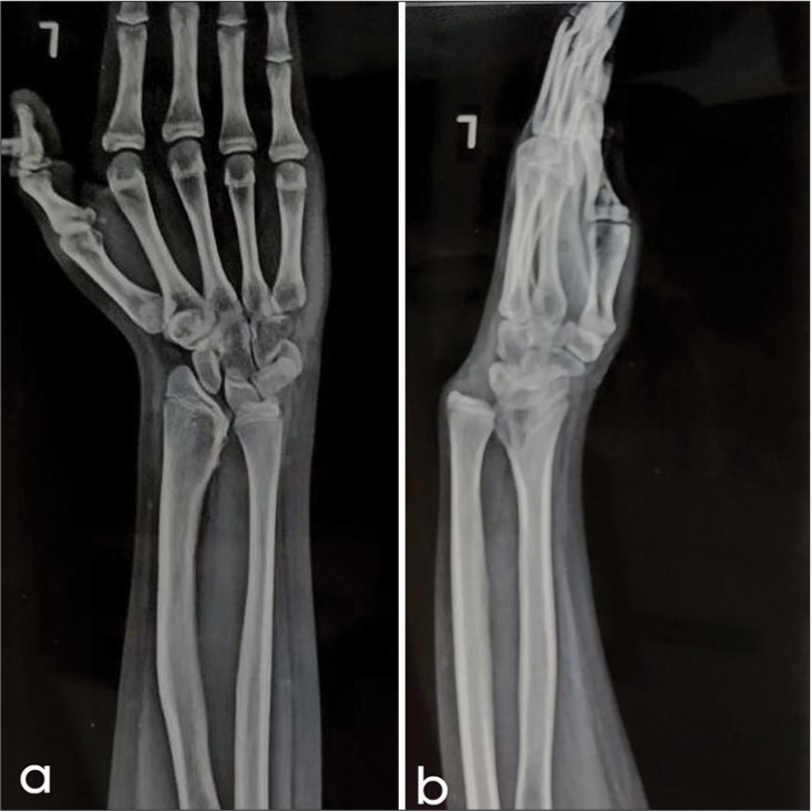 (a) Frontal and (b) Lateral radiographs of the left hand demonstrate Madelung deformity with positive ulnar variance. There is lunate subsidence and wedge-shaped proximal carpal row. Dorsal subluxation of the ulnar head is causing “bayonet” like deformity.