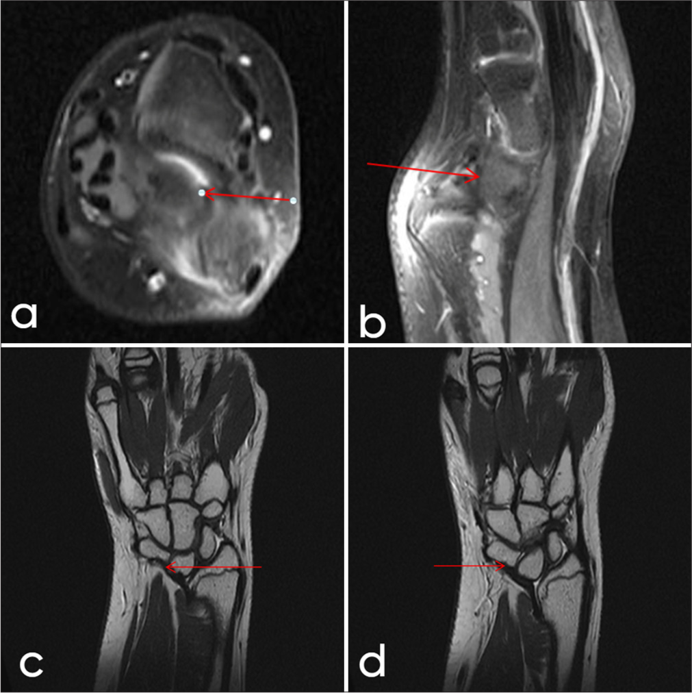 A 12-year-old female. (a) Axial T2, (b) Sagittal, (c) Coronal fluid sensitive magnetic resonance sequences showing radiolunate (Vickers ligament) (red arrow) with associated madelung deformity. (d) Coronal T2W image showing radiotriquetral ligament (red arrow).