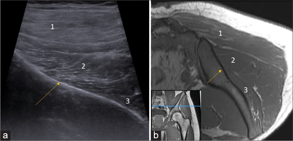 (a) Ultrasonography (US) image and (b) corresponding T1-weighted (non-fat saturated) axial magnetic resonance imaging (MRI) section flipped 180° at the level of iliac blade (descending slope, arrow) demonstrate the layered arrangement of gluteal muscles (1-Gluteus Maximus, 2-Gluteus medius, 3-Gluteus minimus). Inset at the bottom left corner (b) shows the level of acquisition of both US and MRI section indicated by blue line in T1W coronal image of left gluteal region.