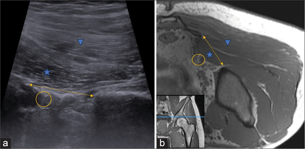 (a) Ultrasonography (US) image and (b) corresponding T1-weighted (non-fat saturated) axial magnetic resonance imaging (MRI) section flipped 180° at the level of greater sciatic notch (double arrow) demonstrate the dip in iliac blade obliquity representing the notch. The Piriformis muscle (asterisk) can be seen traversing horizontally, covered superiorly by the Gluteus maximus muscle (arrowhead). The Sciatic nerve (oval) can be seen located deep in the piriformis and must be protected during regional interventions. Inset at the bottom left corner (b) shows the level of acquisition of both US and MRI section indicated by blue line in T1W coronal image of left gluteal region.