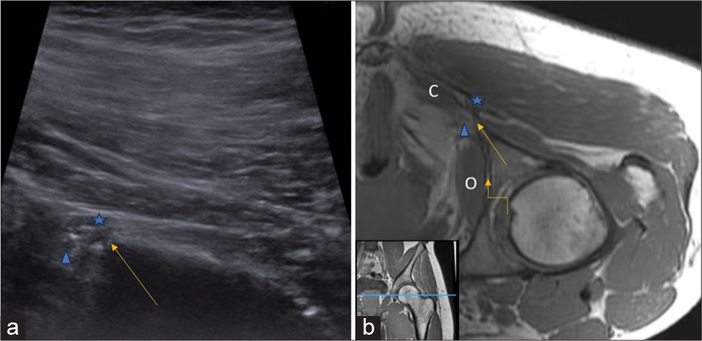 (a) Ultrasonography (US) image and (b) corresponding T1-weighted (non-fat saturated) axial magnetic resonance imaging (MRI) section flipped 180° at the level of ischial spine (arrow) show the sciatic nerve (asterisk) and pudendal nerve (arrowhead) located superficial and deep to ischial spine, respectively. The pudendal nerve courses between the “Lobster’s claw” limited by obturator internus (O) laterally and coccygeus muscle (C) medially into the Alcock’s canal (curved arrow). Inset at the bottom left corner (b) shows the level of acquisition of both US and MRI section indicated by blue line in T1W coronal image of left gluteal region.