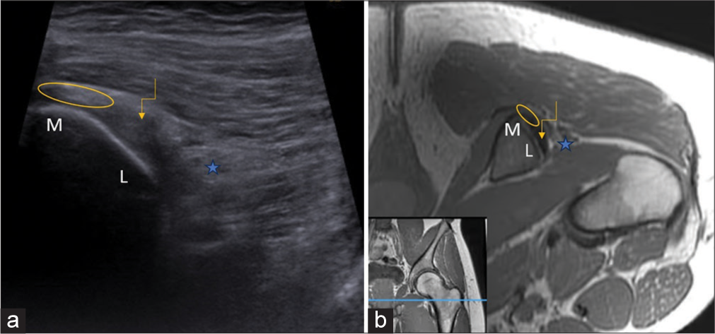 (a) Ultrasonography (US) image (b) and corresponding T1-weighted (non-fat saturated) axial magnetic resonance imaging (MRI) section flipped 180° at the level of ischial tuberosity with its two facets, medial (M) and lateral (L) along with the attachment of conjoint tendon (ellipse) medially and semimembranosus (curved arrow) superolaterally. The sciatic nerve (asterisk) is seen immediately adjacent to semimembranosus attachment. Inset at the bottom left corner (b) shows the level of acquisition of both US and MRI section indicated by blue line in T1W coronal image of left gluteal region.