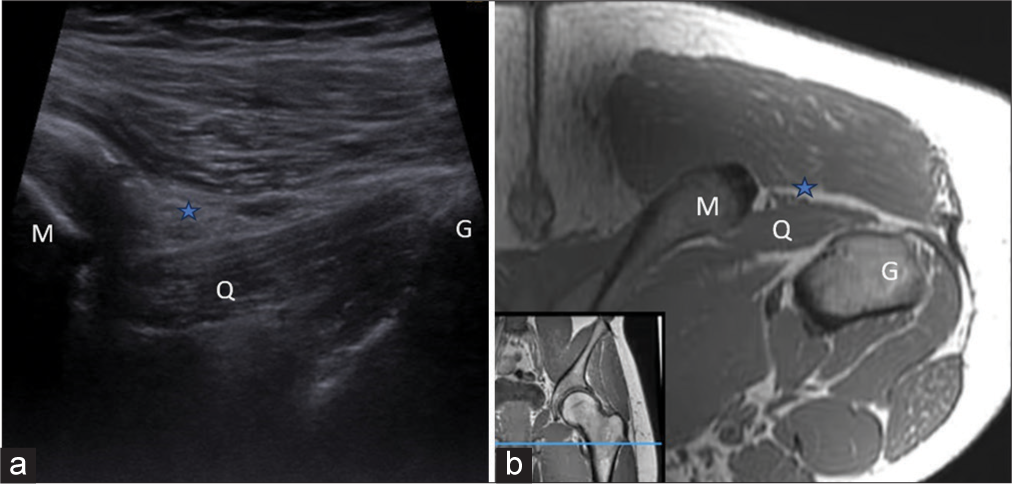 (a) Ultrasonography (US) image and (b) corresponding T1-weighted (non-fat saturated) axial magnetic resonance imaging (MRI) section flipped 180° at the level of greater trochanter lateral plateau (G) shows quadratus femoris muscle (QF) bridging the two plateaus (medial plateau, M and lateral plateau, G) and forming the bed for sciatic nerve (asterisk) to pass into the thigh. These two landmarks also serve to identify the dimensions of ischio-femoral/quadratus femoris space to evaluated ischiofemoral impingement. The greater trochanter (G) is also a frequent site of injury in many patients with greater trochanteric pain syndrome. Inset at the bottom left corner (b) shows the level of acquisition of both US and MRI section indicated by blue line in T1W coronal image of left gluteal region.