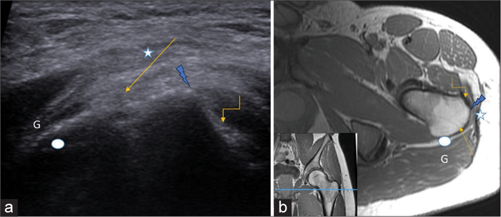 (a) Axial ultrasound image and (b) corresponding T1-weighted axial non-fat saturated image demonstrate the anatomy of greater trochanter. The anterior facet harbors Gluteus minimus tendon insertion (curved arrow), the flattened lateral facet serves as an attachment for Gluteus medius (straight arrow), and the beginning of posterior facet (white oval) covered by Gluteus maximus (G. maximus) muscle (G). Iliotibial band (asterisk) is seen extending between G. maximus muscle and tensor fascia lata. The pyramidal-shaped bony projection between anterior and lateral facets is clearly seen (lightening arrow). Inset in (b) shows the level of acquisition of both US and MRI section indicated by blue line in T1W coronal image of left gluteal region.