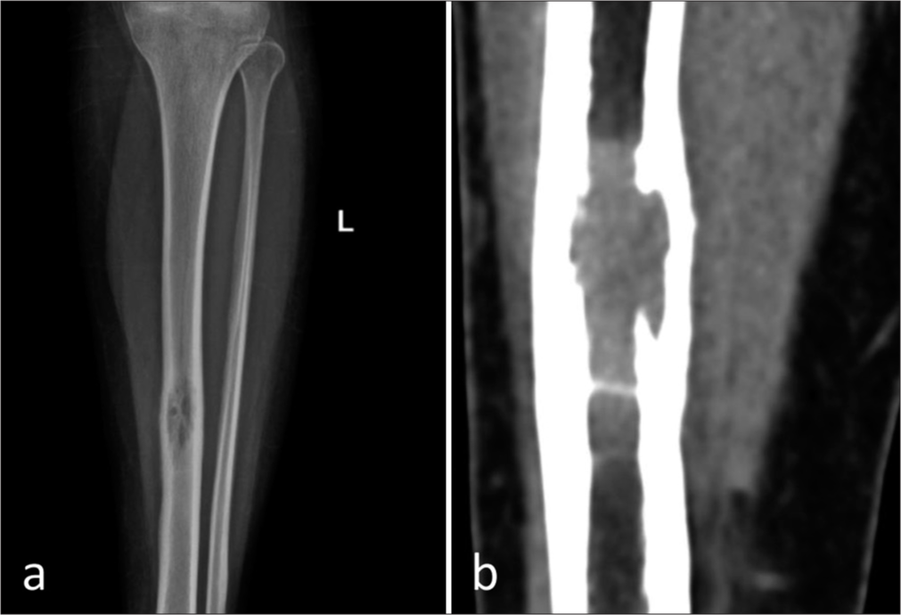 (a) Plain anteroposterior and (b) computed tomography of the left leg showing a solitary, expansile, intramedullary osteolytic lesion with a narrow zone of transition in the mid diaphysis of the left tibia. The lesion is causing endosteal scalloping and involves anterior and posterior cortices. No obvious periosteal reaction. No cortical break. No soft-tissue component.