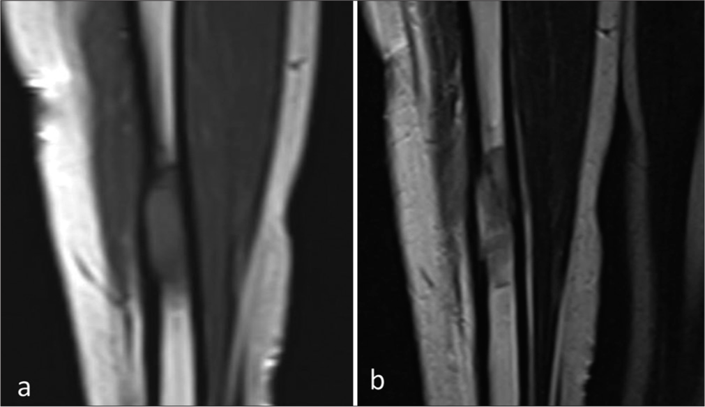 (a) Coronal T1- (b) and T2-weighted magnetic resonance image showing a well-defined intramedullary marrow infiltrating lesion which is hypointense on the T1-weighted image and hyperintense on T2-weighted image in the mid-diaphysis of the tibia. No adjacent soft-tissue component.