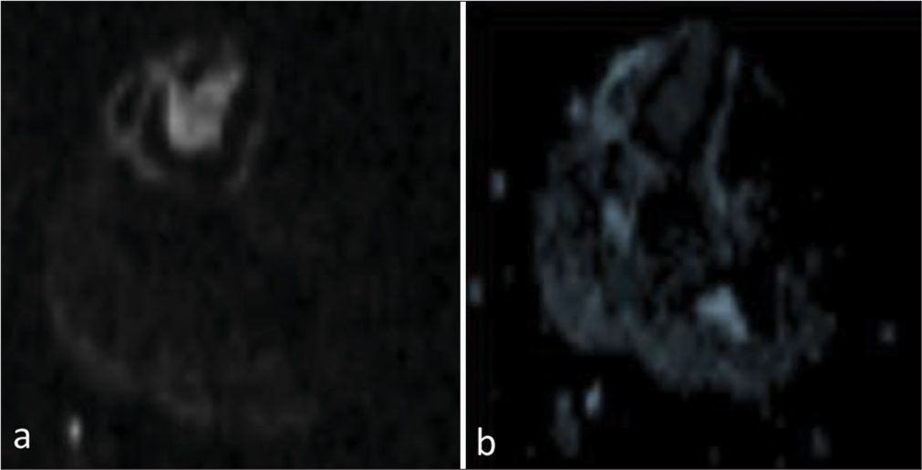 (a) Diffusion-weighted image and corresponding (b) apparent diffusion coefficient image showing restricted diffusivity.