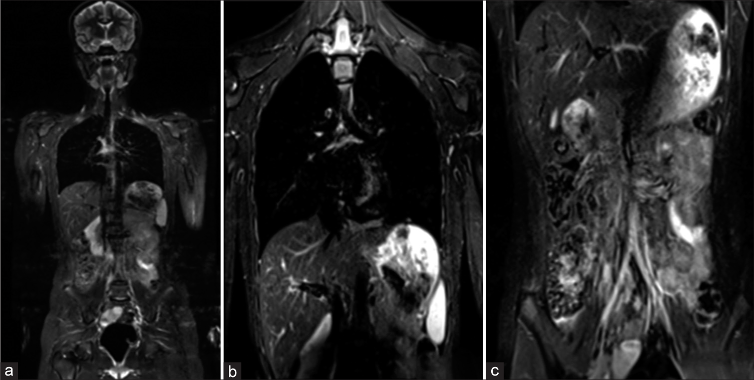 (a-c) Whole-body magnetic resonance imaging showing no synchronous involvement of the other systems.