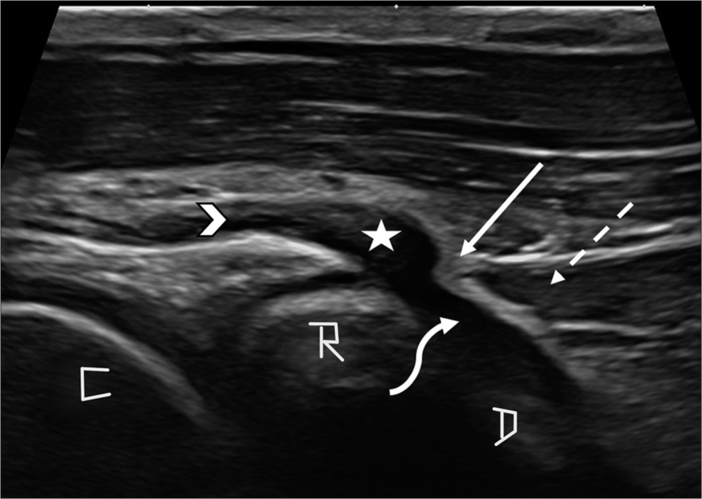 Sagittal ultrasound scan at the level of proximal forearm showed focal swelling of the posterior interosseous nerve (star), proximal to the superior edge of superficial head of supinator muscle (dashed arrow). The nerve was normal in diameter proximal (arrowhead) and distal (curved arrow) to this location. Echogenic thickening of Ligament of Frohse (solid arrow) was also noted. C: Capitellum, D: Deep head of supinator muscle, R: Radius head.