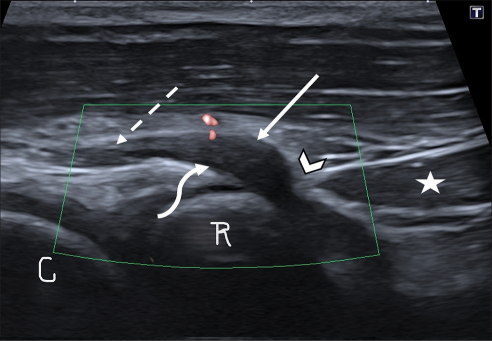 Ultrasound examination revealed a hypoechoic posterior interosseous nerve at the site of focal swelling (solid arrow), just proximal to the site of compression by ligament of Frohse (arrowhead). No increase in internal vascularity of nerve was noted on color Doppler examination (curved arrow). Normal echogenicity and diameter of nerve were noted proximal to the site of swelling (dashed arrow). Star: Superficial head of supinator muscle, C: Capitellum, R: Radius head.