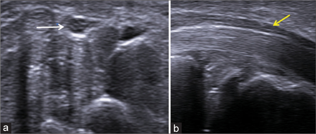 (a) Transverse axis and (b) longitudinal axis ultrasound images of the median nerve showing the honeycomb appearance of the nerve (white arrow) and alternating hypoechoic and hyperechoic bands (yellow arrow), respectively.