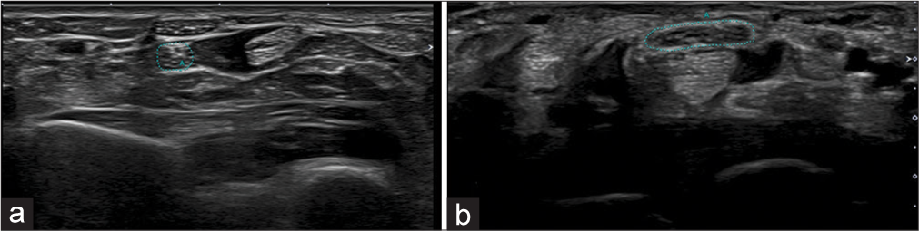 (a) Transverse axis ultrasound images at the level of the pronator quadratus (Green dots) and (b) at the level of the carpal tunnel showing measurement of the cross-section area of the median nerve (Green dots).