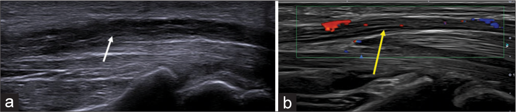 (a) Longitudinal axis ultrasound image of the median nerve showing thickened hypoechoic nerve fascicles (white arrow) and (b) Doppler image showing intra-neural vascularity (yellow arrow).